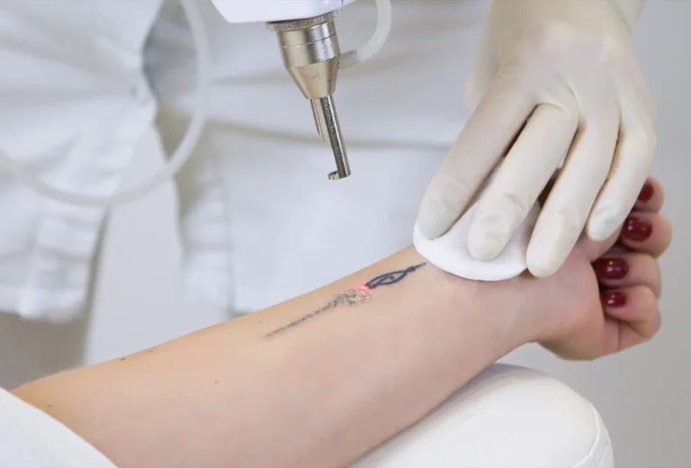 Skin Addiction - Tattoo Removal Hockley 03